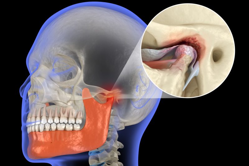 Close up image of TMJ joint