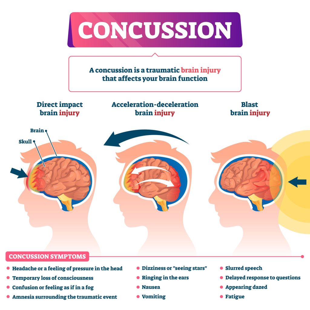 Concussion examples