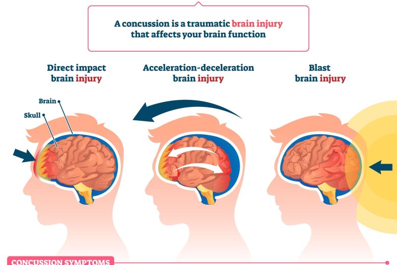 concussion types